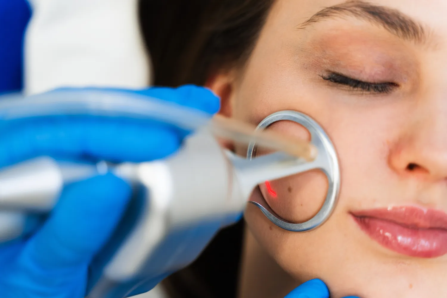 CO₂ Skin Resurfacing Treatments