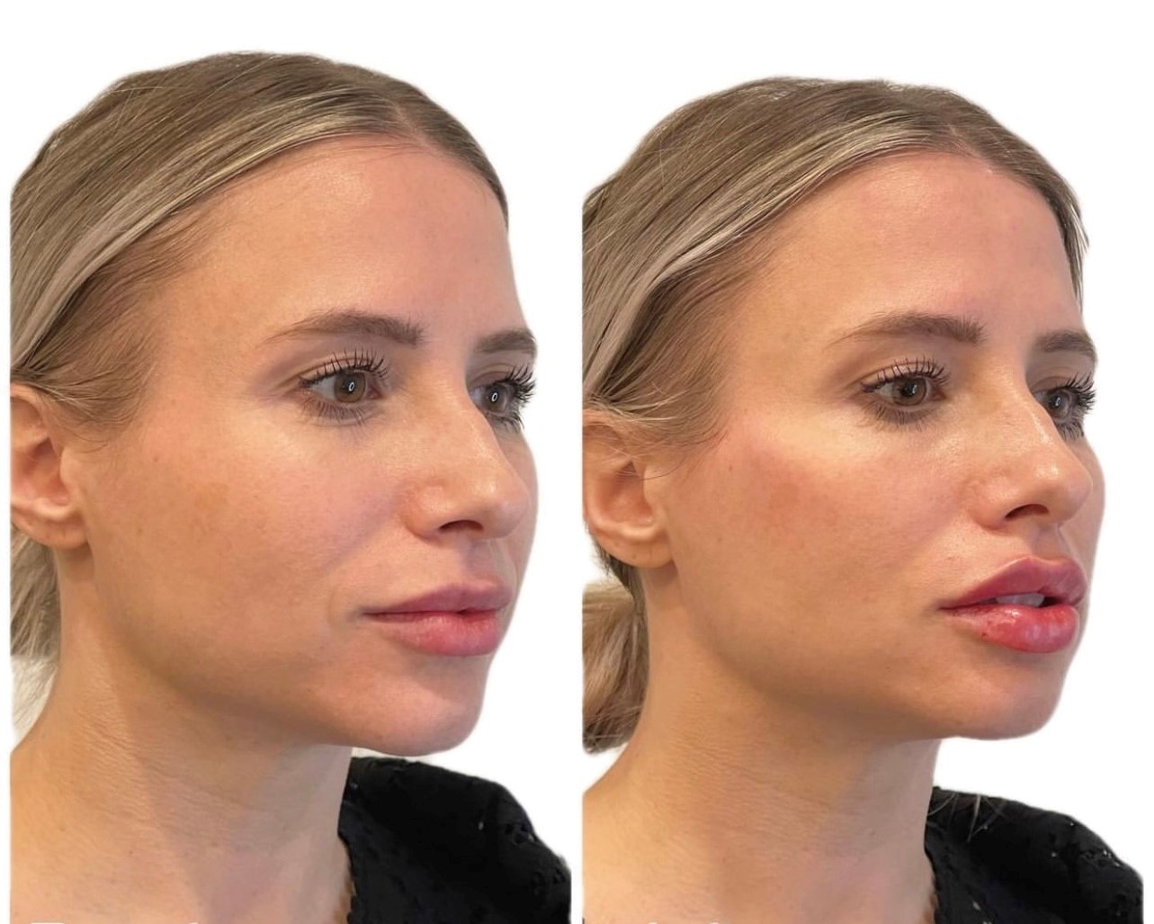 Before and After Lip Filler and Full Face Hydrafacial